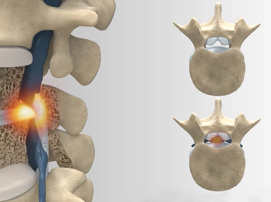 MRI Spine Imaging at the Esaote Event in Catania