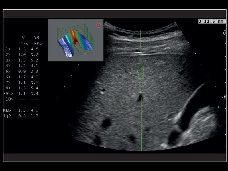 MyLab™X8 Platform - Stiffness quantification with Q-ElaXto