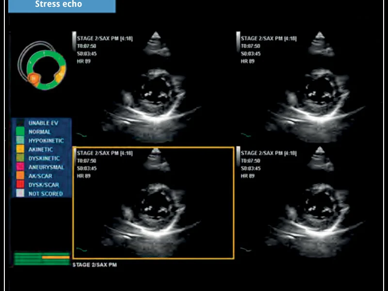MyLab™X5 - Stress echo