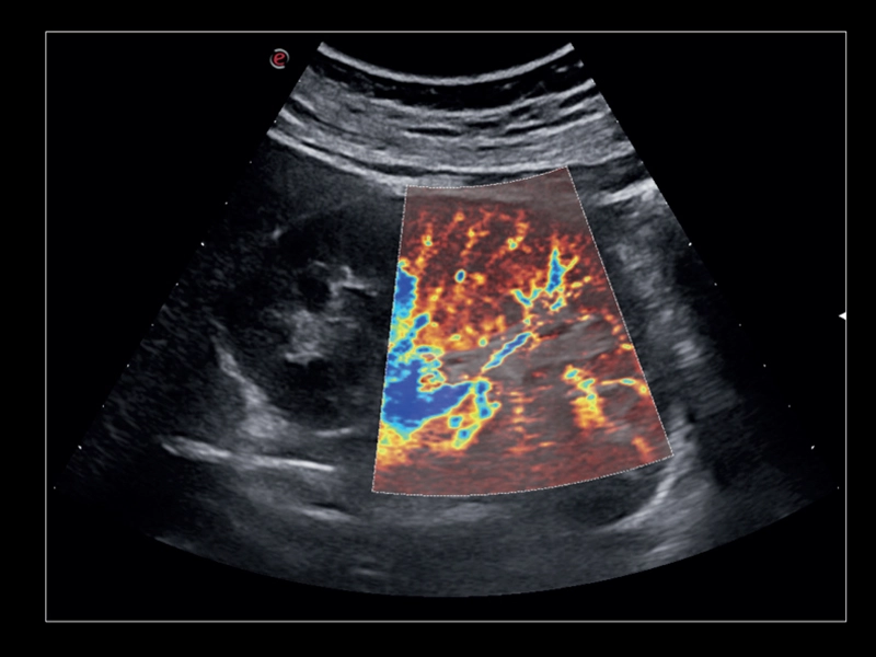 MyLab™X8 Platform - Tissue perfusion visualisation with microV