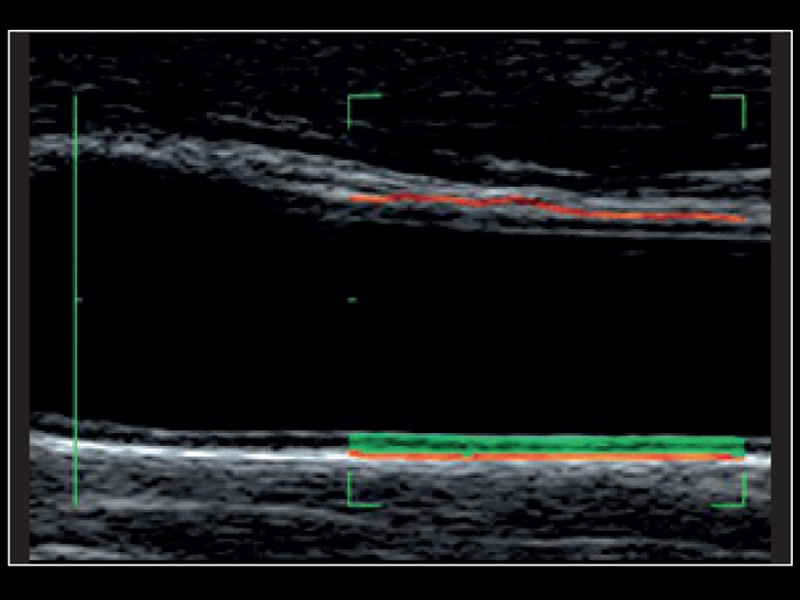 MyLab™X8 Platform - Real-time measurement of the Intima Media with QIMT
