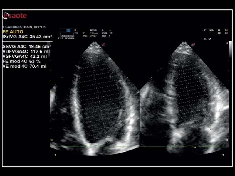 MyLab™X8 Platform - Zero-click EF measurement with Uterus - XLight 3D/4D exploration AutoEF