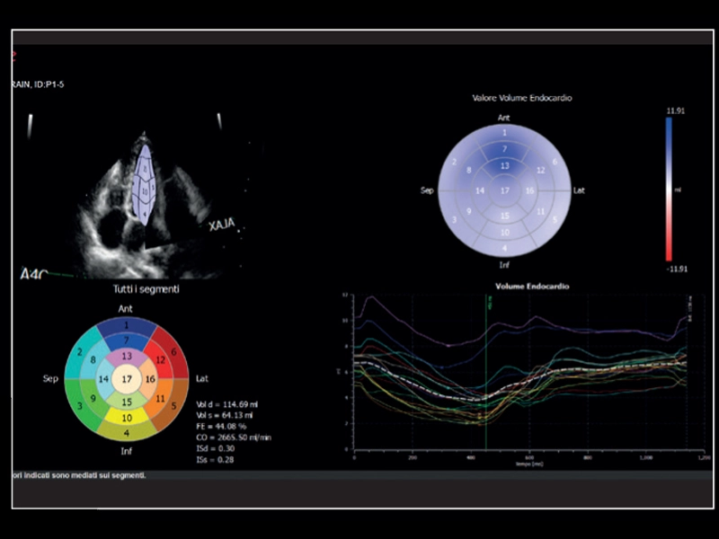 MyLab™X8 Platform - Volumetric model of the left function with XStrain4D