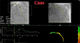 The innovative software "CAAS vFFR" by Pie Medical Imaging