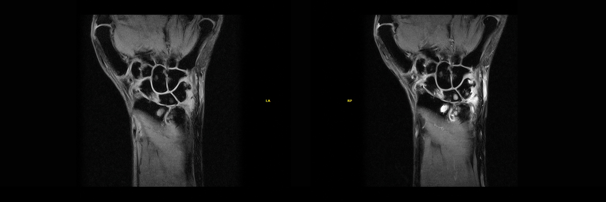 Dynamic MRI analysis – rheumatology