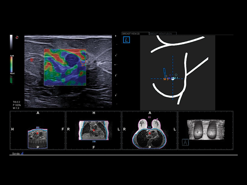 Breast clinical image