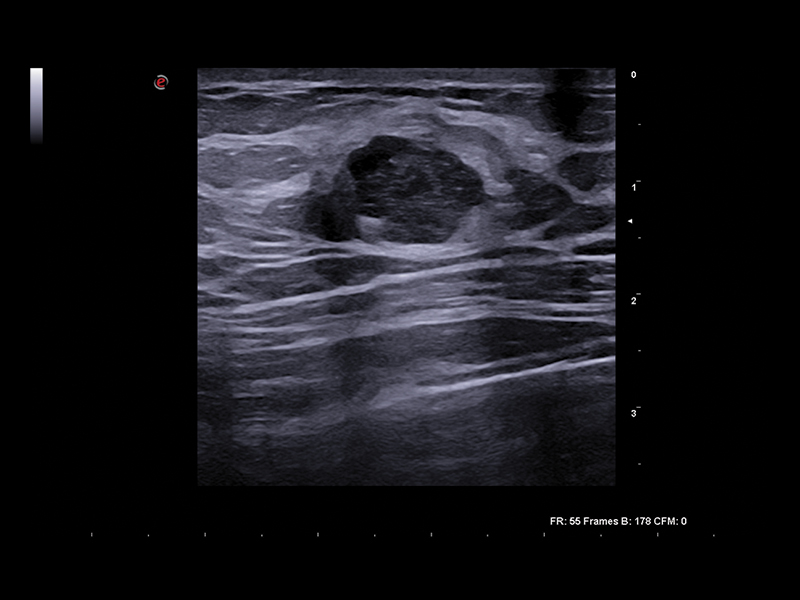Breast clinical image