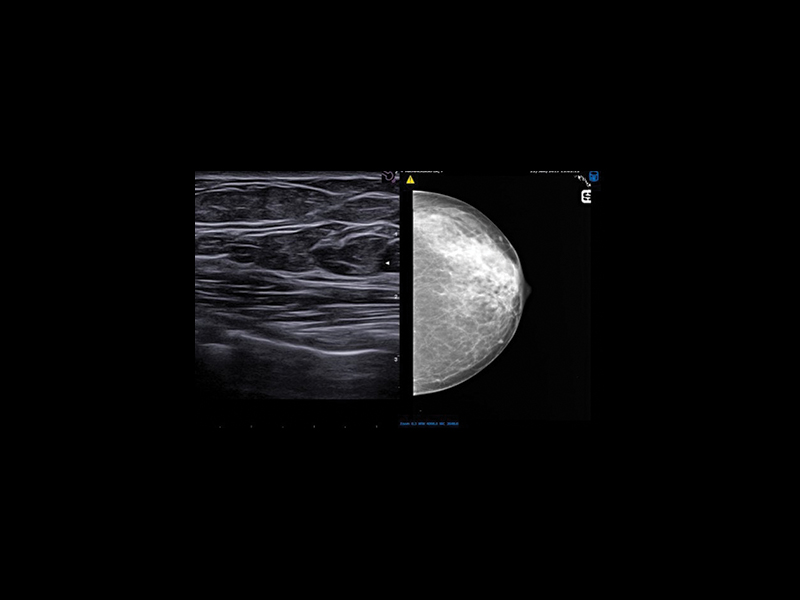 Breast clinical image