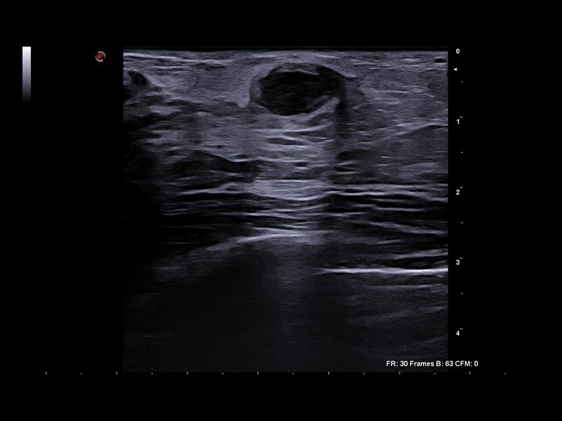 Breast clinical image