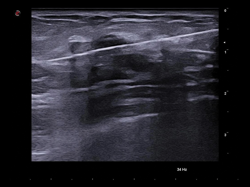 Breast clinical image