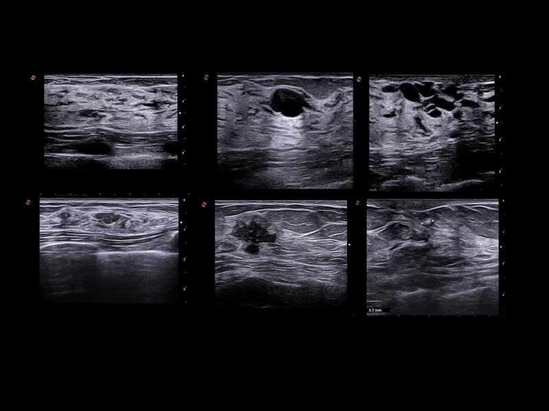 Breast clinical image