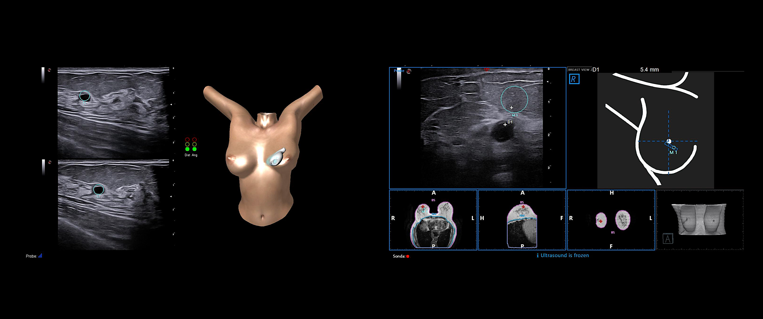 BreastNav™ & BreastNav™ MRI, Second-look & Follow up