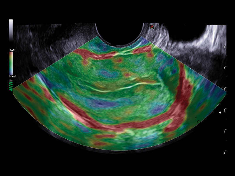 Gynaecology clinical image