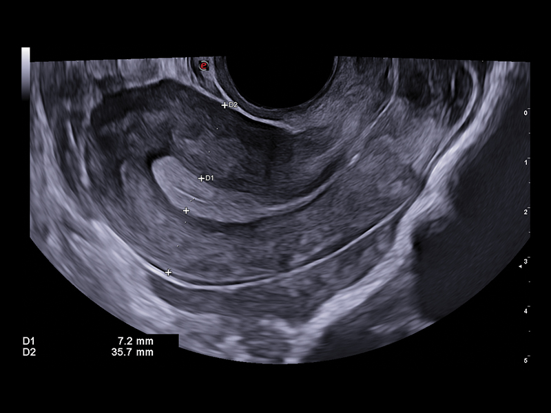 Gynaecology clinical image
