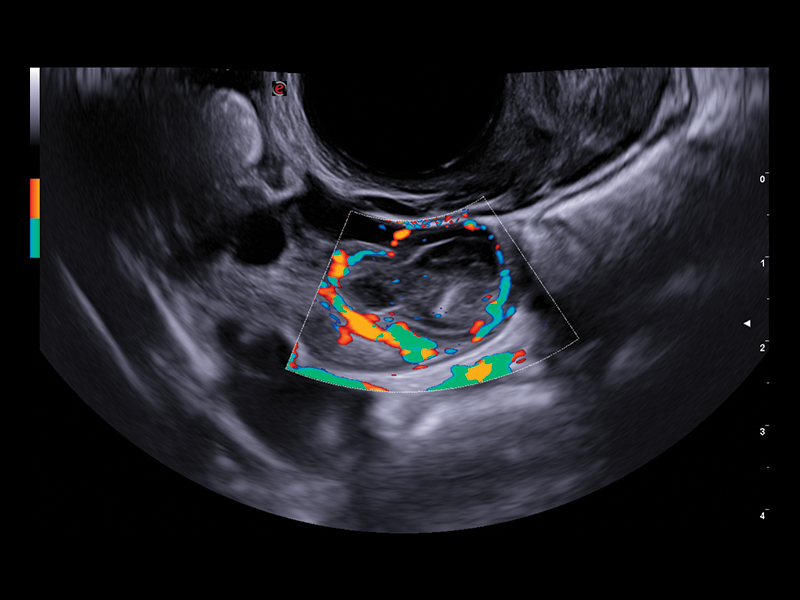 Gynaecology clinical image