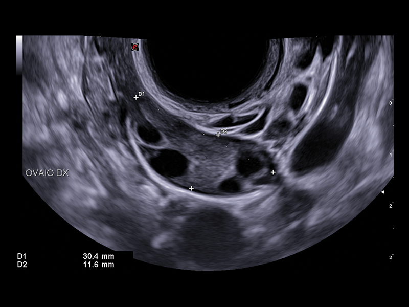 Gynaecology clinical image