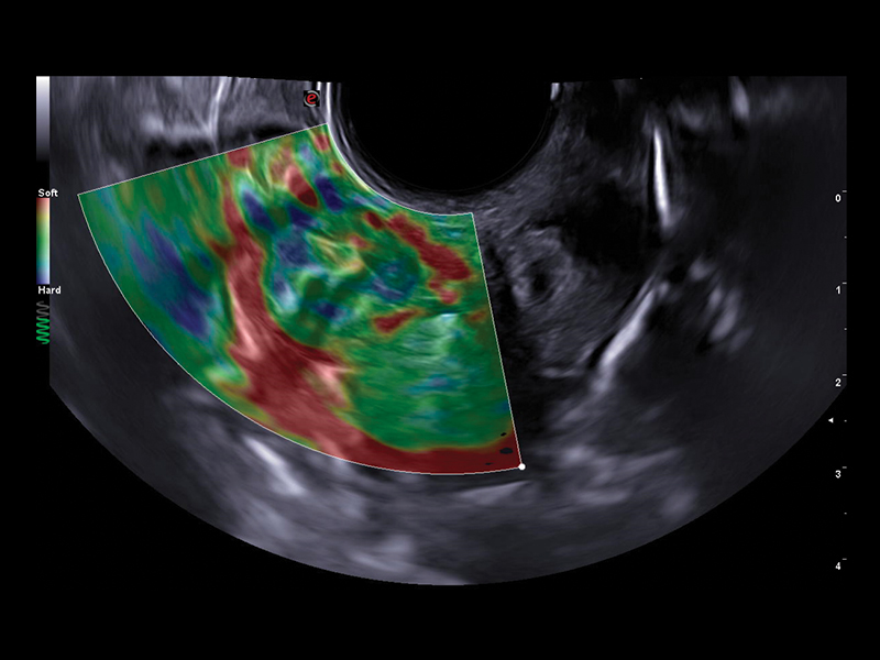 Gynaecology clinical image