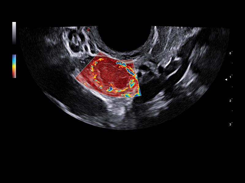 Gynaecology clinical image