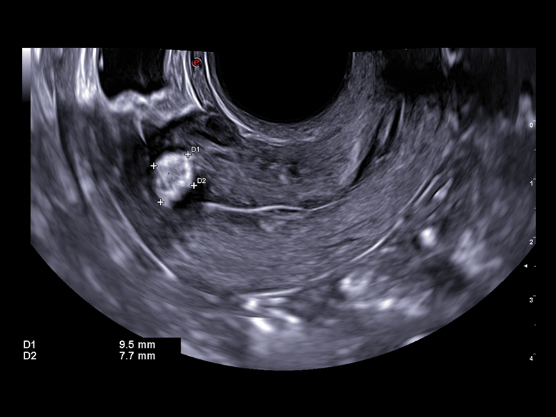 Gynaecology clinical image