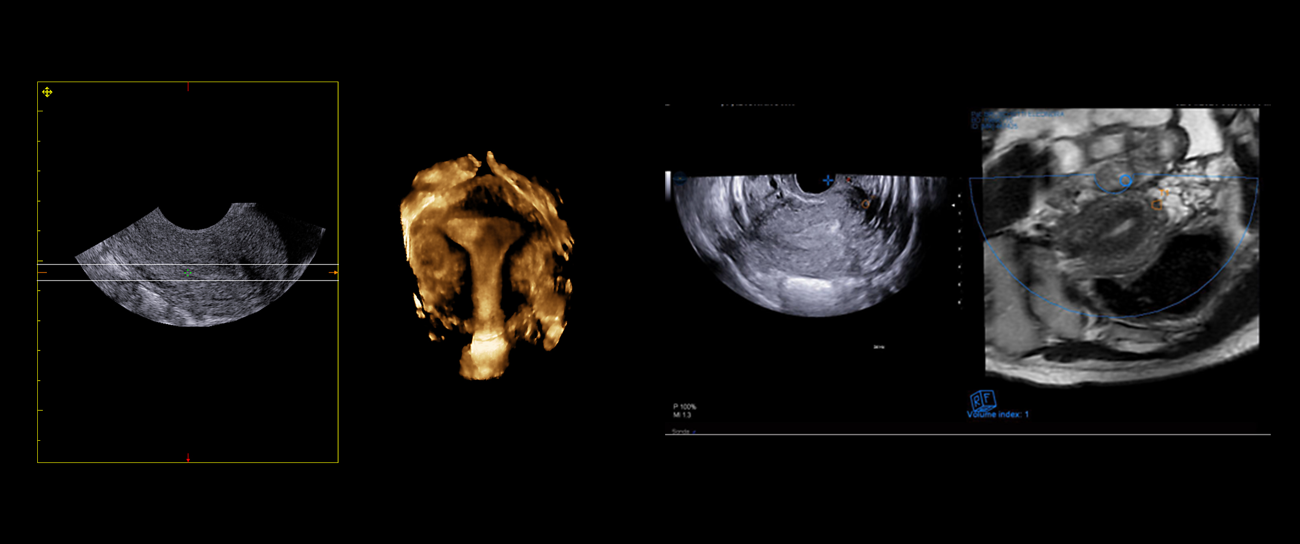 Explorations of complex pelvis conditions