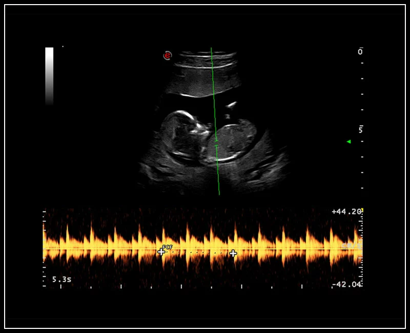 MyLab™9 Platform - easyTrace to maximize Doppler performance