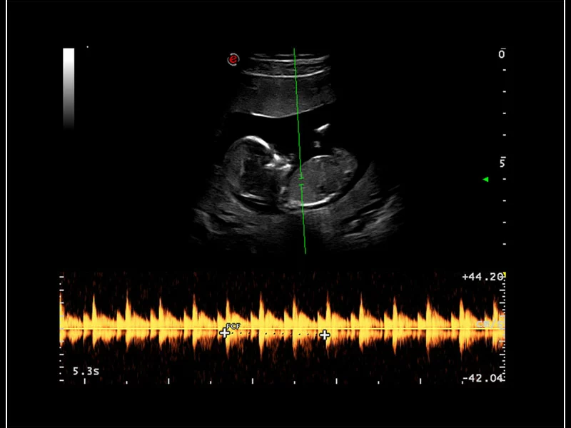 MyLab™9 Platform - easyTrace to maximize Doppler performance