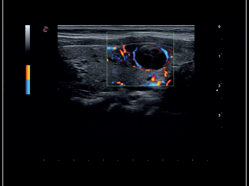 MyLab™Sigma - Thyroid lesion, imaging 2D with Color Doppler
