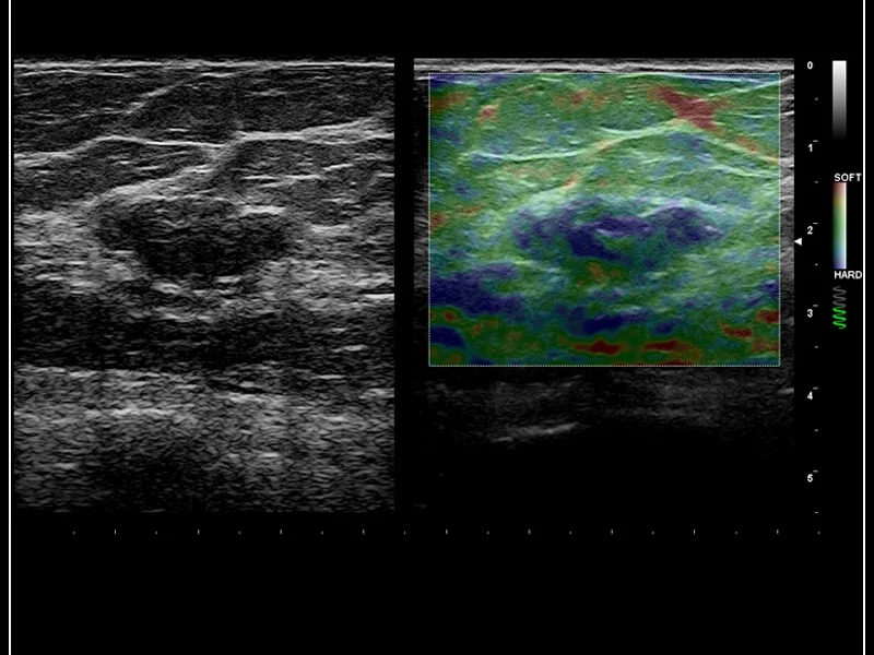 MyLab™9 Platform - Dual ElaXto characterization on breast lesion