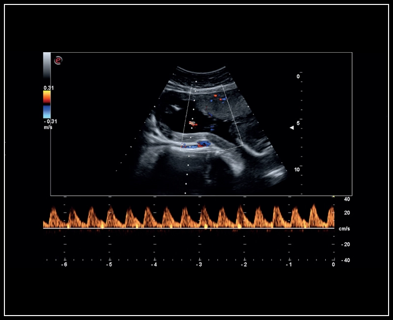 MyLab™Sigma - Umbelical cord PW Doppler mode