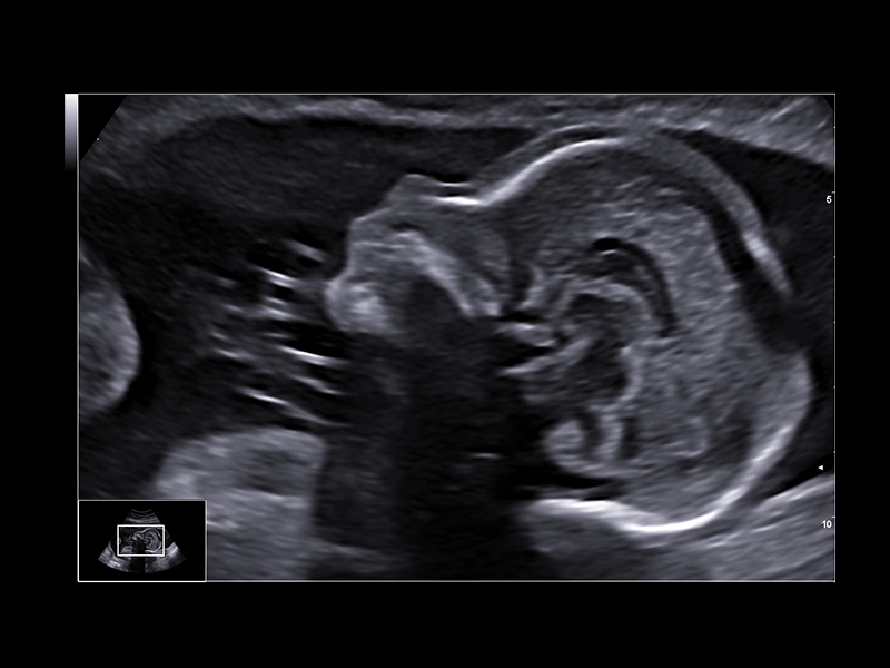 MyLab™E80 - B-Mode - Baby Profile