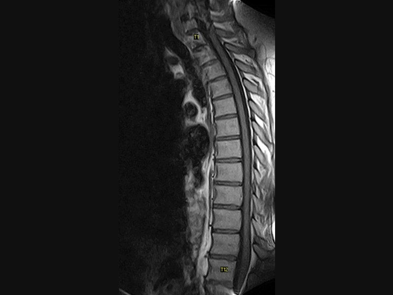 Magnifico™Open - Dspine SE T1 sagittal