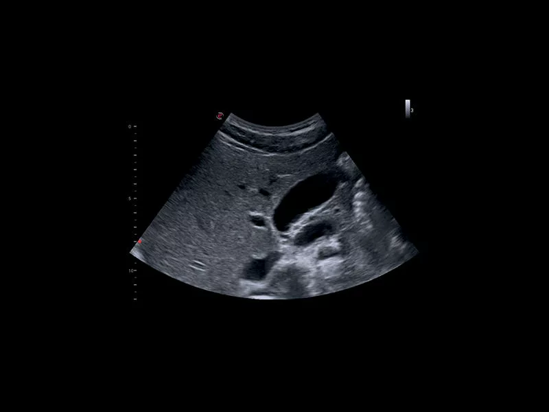 MyLab™X1 - Abdominal liver