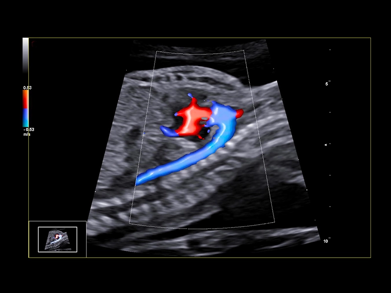 MyLab™E80 - BrightFlow - Aortic Arch