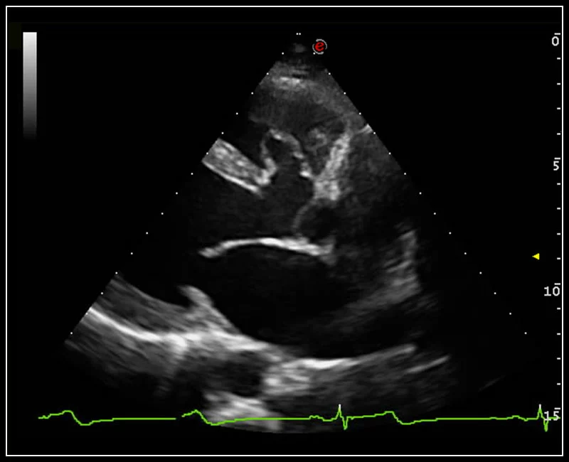 MyLab™9 Platform - TEI™ harmonic imaging for clear visualization of perimembranous ventricular septal