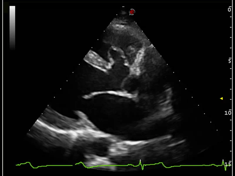 MyLab™9 Platform - TEI™ harmonic imaging for clear visualization of perimembranous ventricular septal
