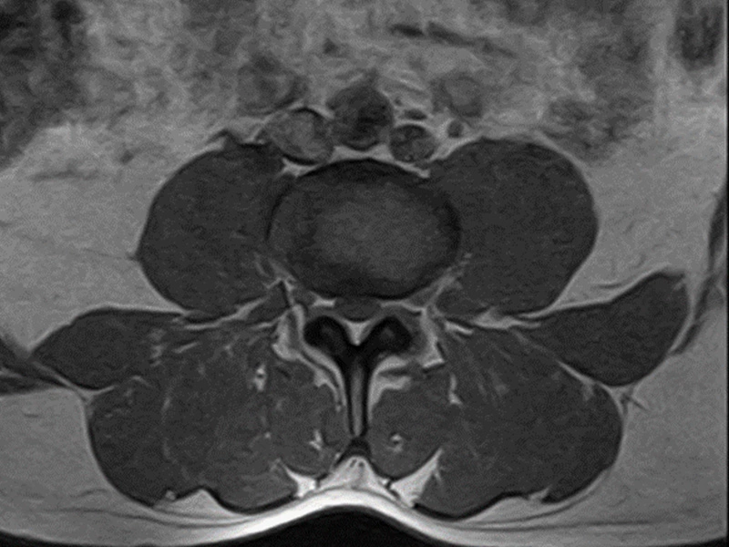 Magnifico™Open - Lspine SE T1 axial