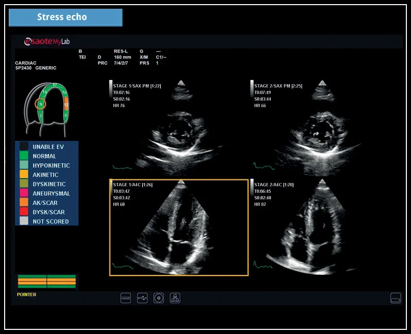 MyLab™X6 - Stress echo