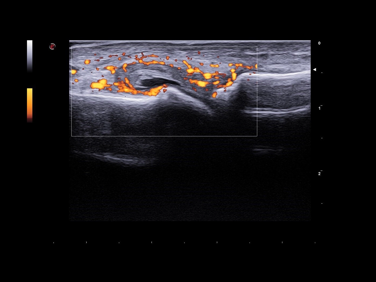 Visualization and Quantification of Synovial Tissue