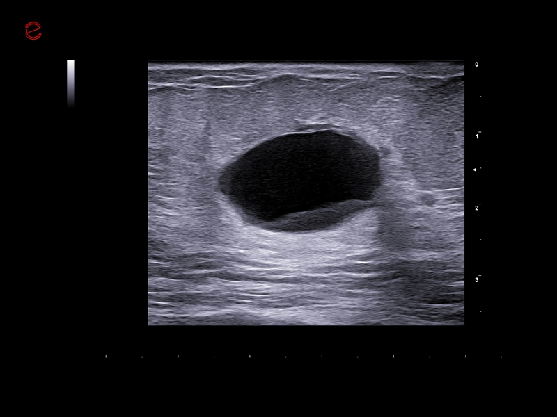 MyLab™C25 - Breast lesion