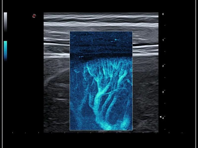 MyLab™9 Platform - Hemodynamics analysis using microV on kidney