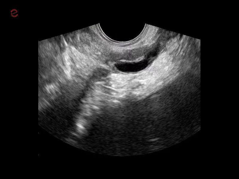 Q7 - WH Uterus