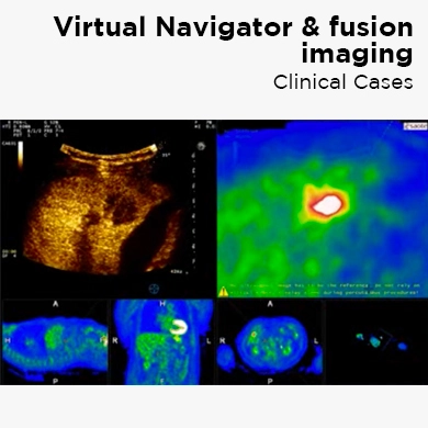 Virtual Navigator & fusion imaging - Clinical Cases
