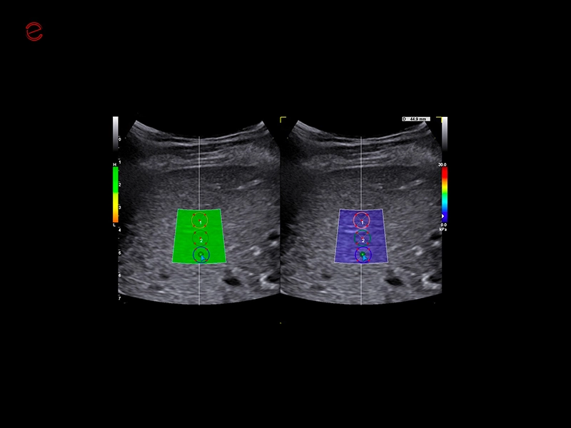 MyLab™C30 - QElaxto 2D liver