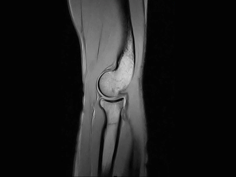 Magnifico™Open - Elbow SE T2 sagittal