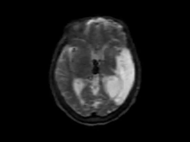 Magnifico™Open - B Value 20