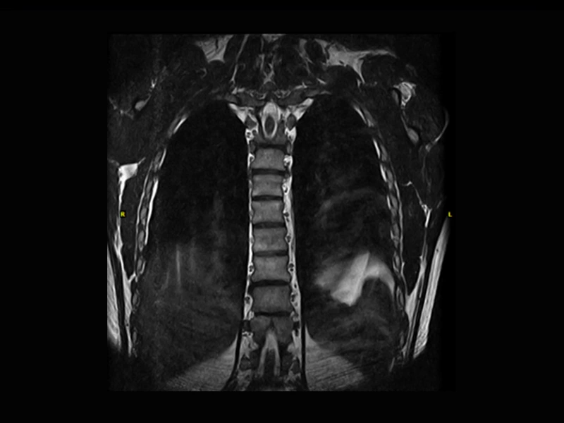 Magnifico™Open - Dspine 3DHYCE coronal