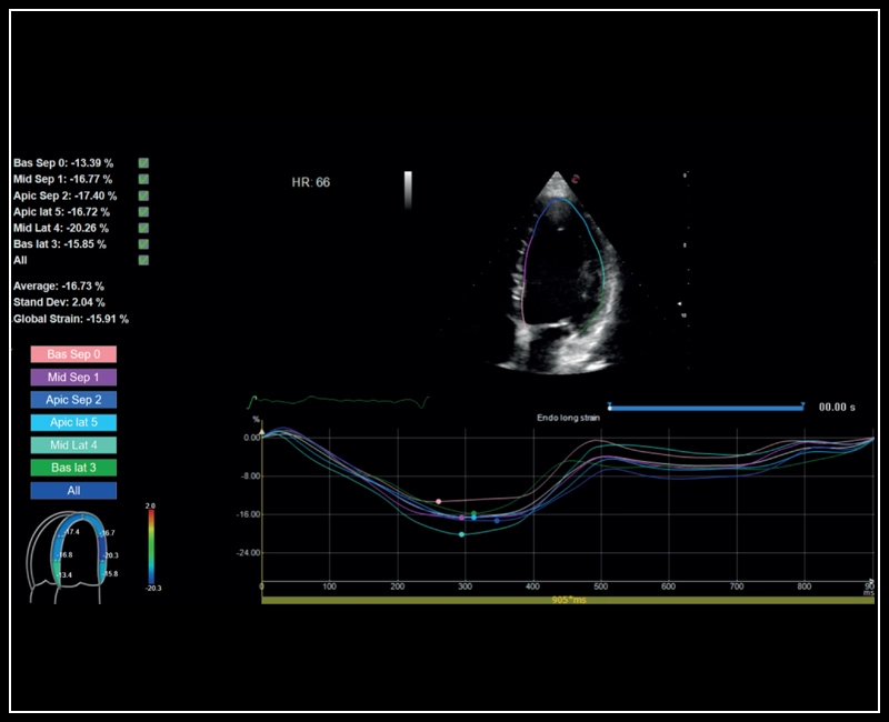 MyLab™Sigma - Left Ventricle XStrain 2D analysis
