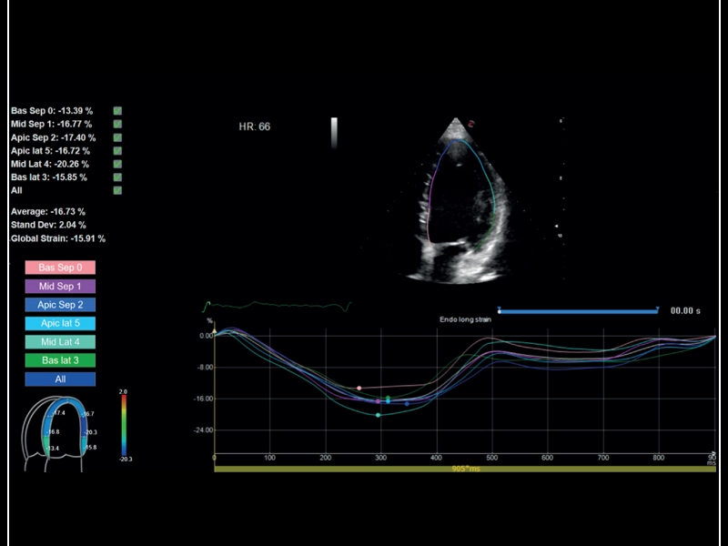 MyLab™Sigma - Left Ventricle XStrain 2D analysis