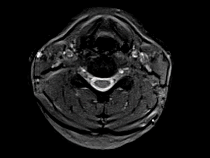 Magnifico™Open - Cspine GE T2 axial