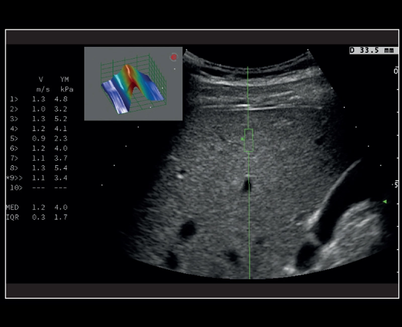 MyLab™X8 Platform - Stiffness quantification with Q-ElaXto